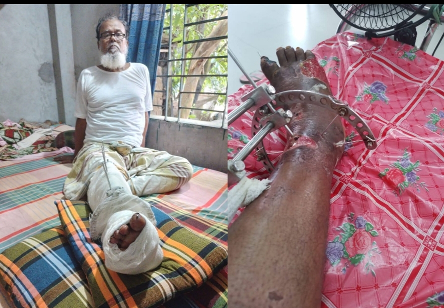 অসুস্থ নুরুজ্জামান চিকিৎসার জন্য আবারও পঙ্গু হাসপাতালে ভর্তি, তার চিকিৎসার জন্য আর্থিক সহায়তা প্রয়োজন!