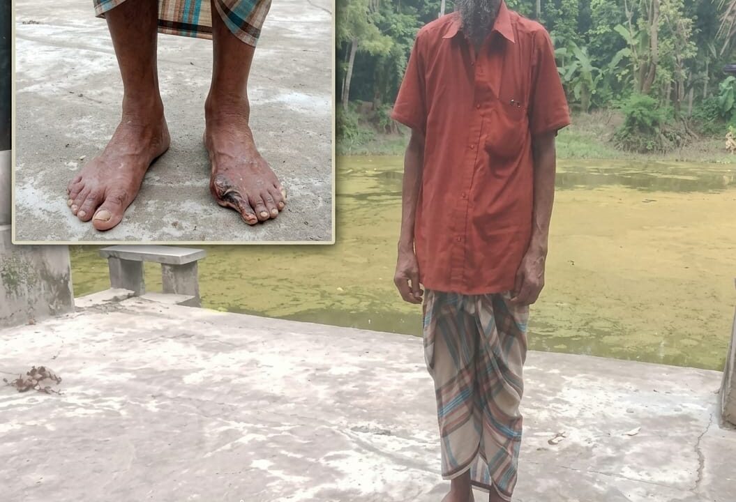 গ্যাংগ্রিনে আক্রান্ত সিদ্দিকুর রহমানের বাঁচার আকুতি, চিকিৎসার জন্য প্রয়োজন মানবিক সহায়তা