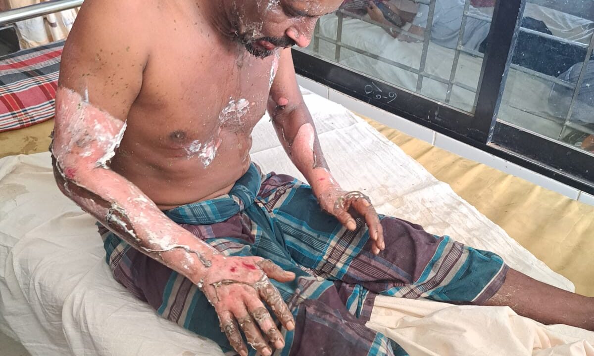 পেট্রোল ঢেলে শ্রমিক সর্দারকে পুড়িয়ে দেওয়ার অভিযোগ, রাজশাহী মেডিক্যালে চিকিৎসাধীন